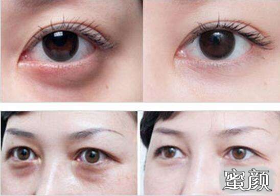 科技揭秘，最新去眼袋最佳方法，重塑眼部美麗新篇章！