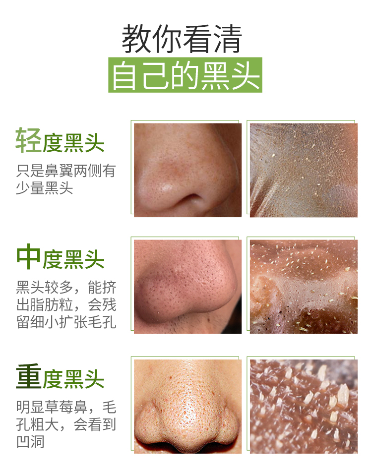 最新去黑頭教程視頻匯總，科技助力美麗重塑，黑頭無憂新篇章